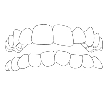 Affollamento Dentale